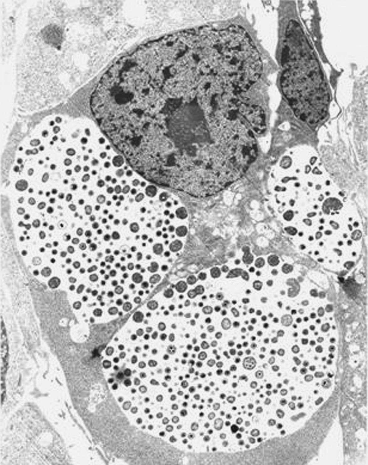 Chlamydial intracellular inclusions filled with smaller dense elementary bodies and...