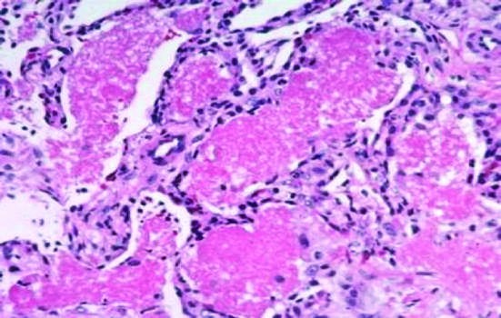 Direct microscopy of Pneumocystis pneumonia