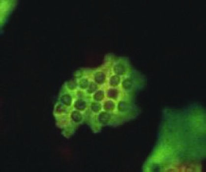 Direct microscopy of Pneumocystis pneumonia