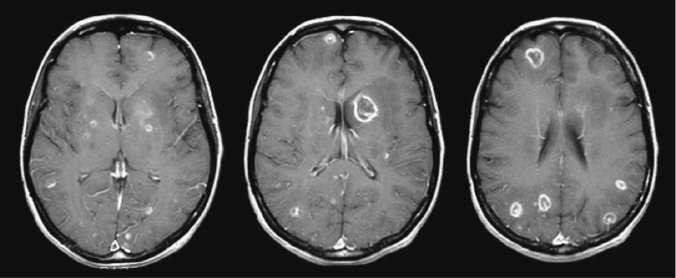 Toxoplasmic encephalitis in a 36-year-old patient with AIDS
