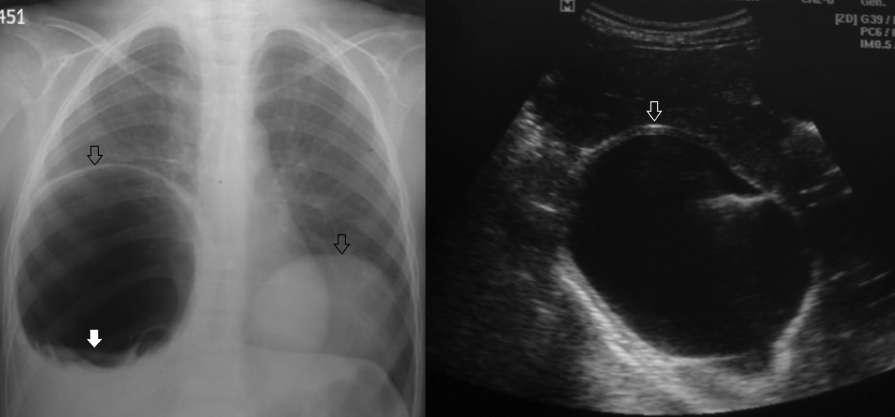 Imaging studies of cystic echinococcosis