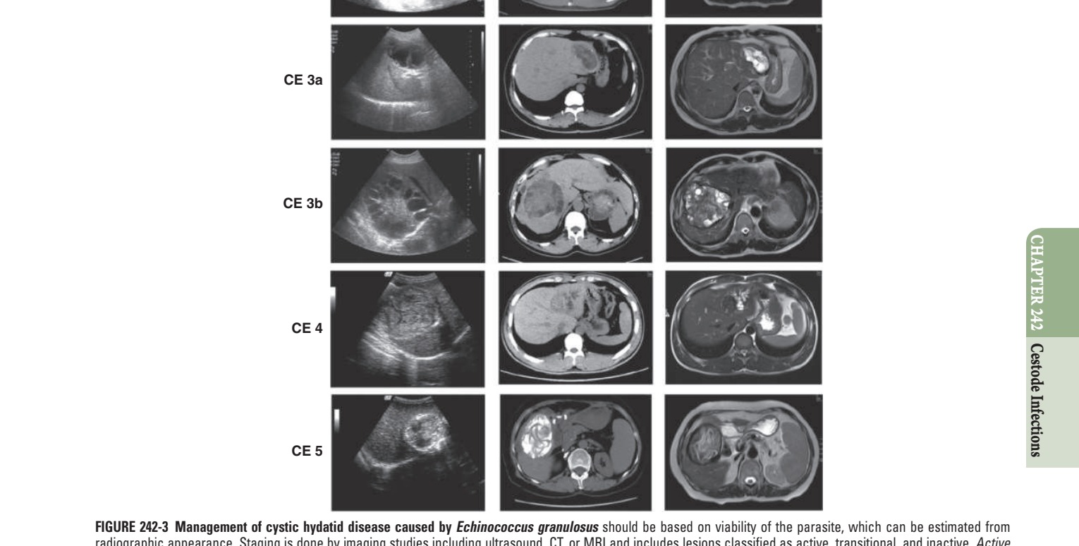 Management of cystic hydatid disease caused by Echinococcus radiographic appearance
