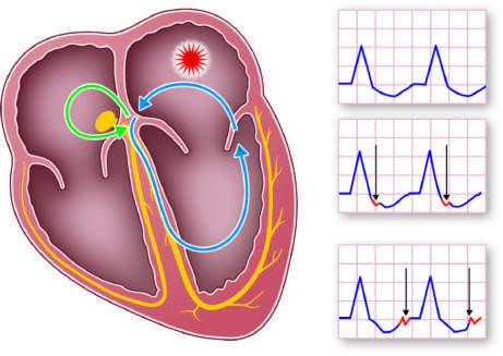 Common mechanisms underlying paroxysmal supraventricular view of the heart with...