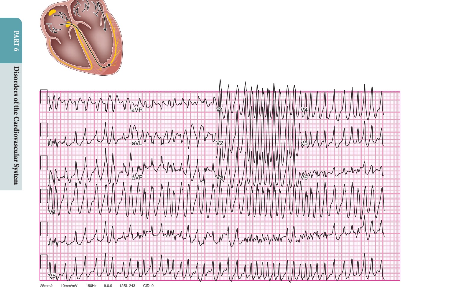 Preexcited atrial fibrillation (AF) due to conduction over a left...