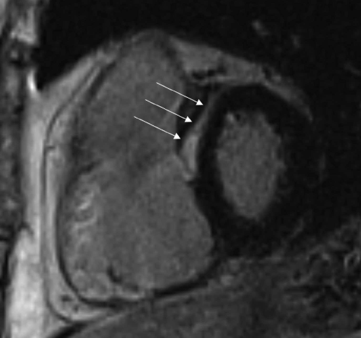 Cardiac magnetic resonance image (MRI)