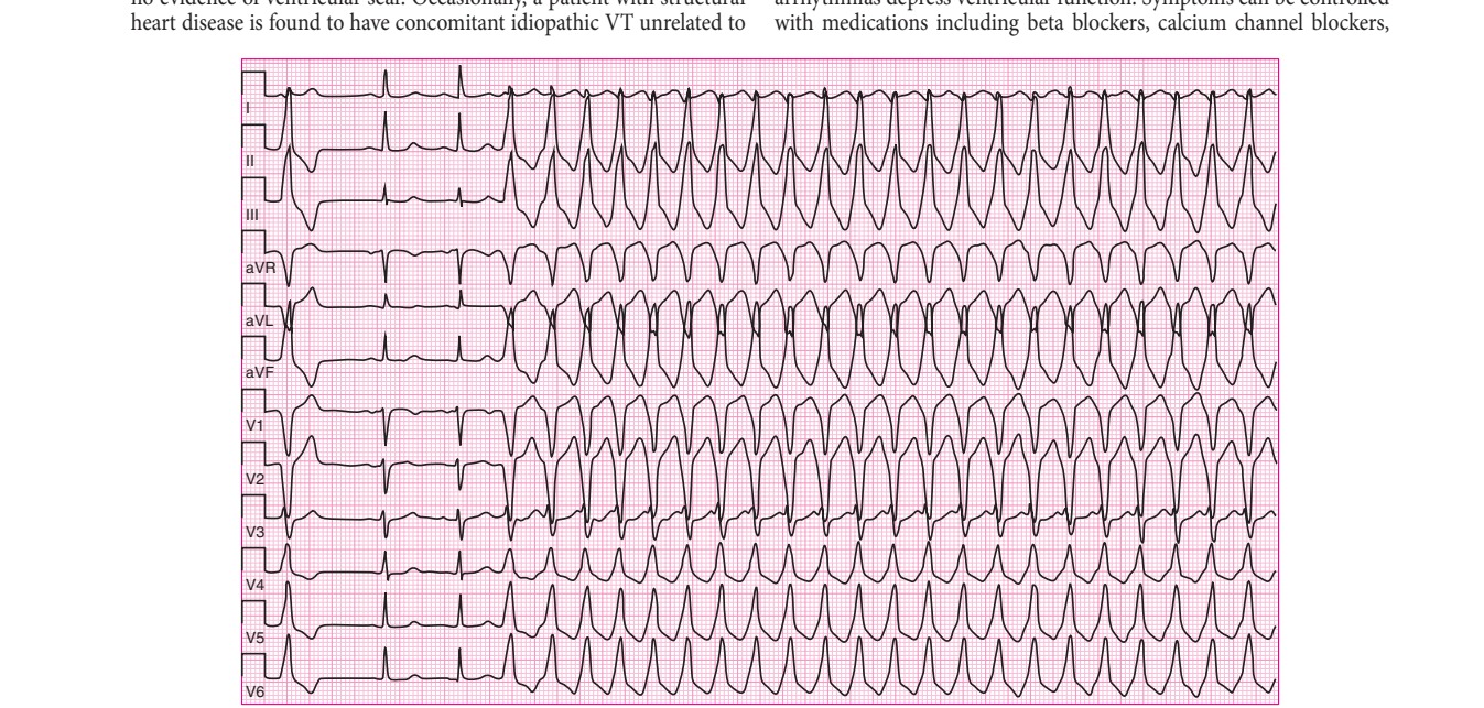 Idiopathic monomorphic ventricular tachycardia (VT)