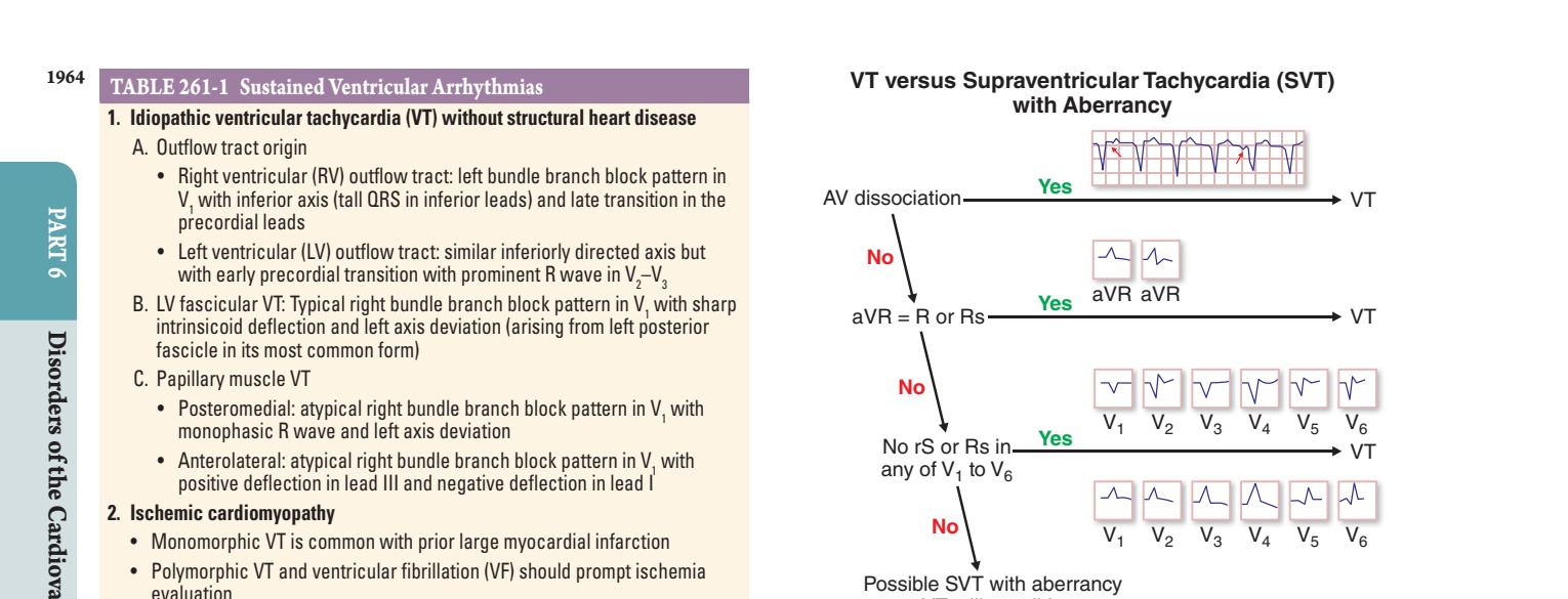 Algorithm for differentiation of ventricular tachycardia (VT) from supraventricular tachycardia...