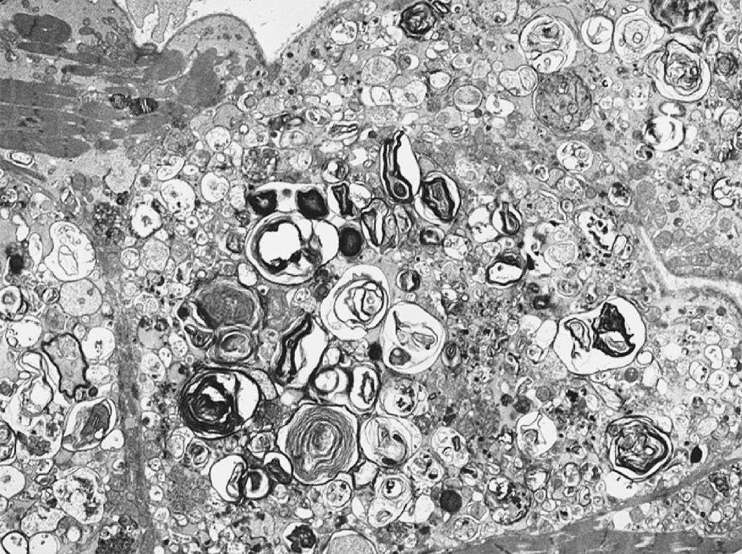 Fabry’s disease