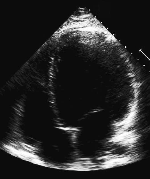 Dilated cardiomyopathy