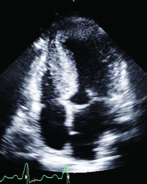 Hypertrophic cardiomyopathy