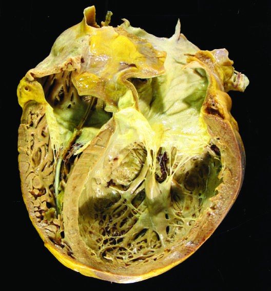 Dilated cardiomyopathy