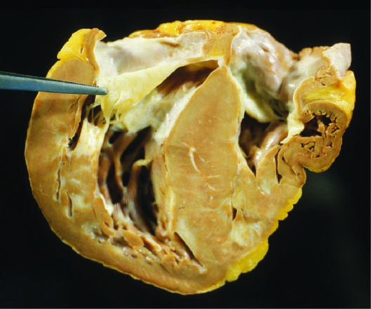 Hypertrophic cardiomyopathy