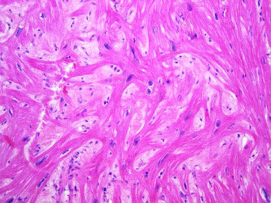 Hypertrophic cardiomyopathy