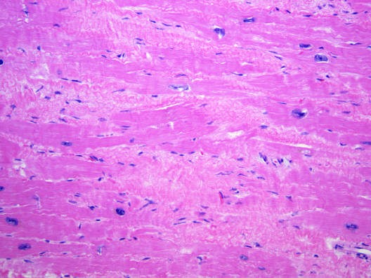 Dilated cardiomyopathy