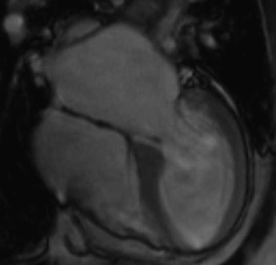 Hemochromatosis