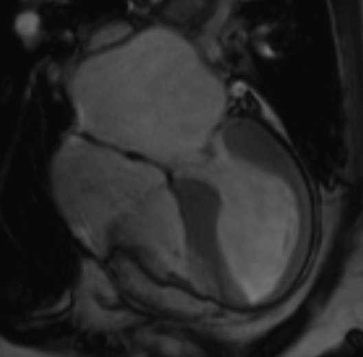 Hemochromatosis