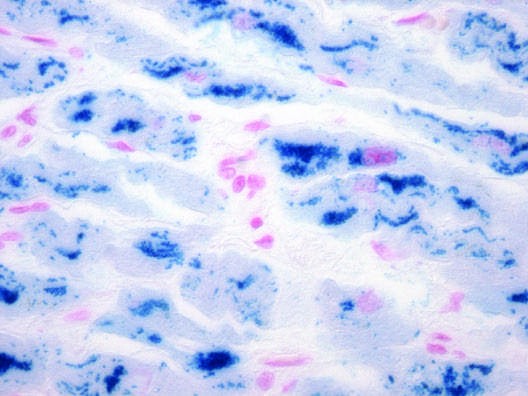 Hemochromatosis