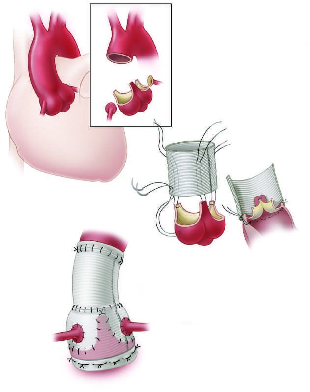 Valve-sparing aortic root reconstruction (David procedure)