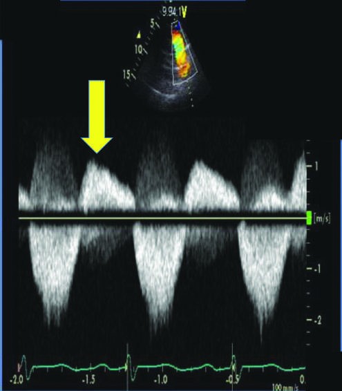 Echocardiographic and Doppler depiction of severe aortic shows a broad...