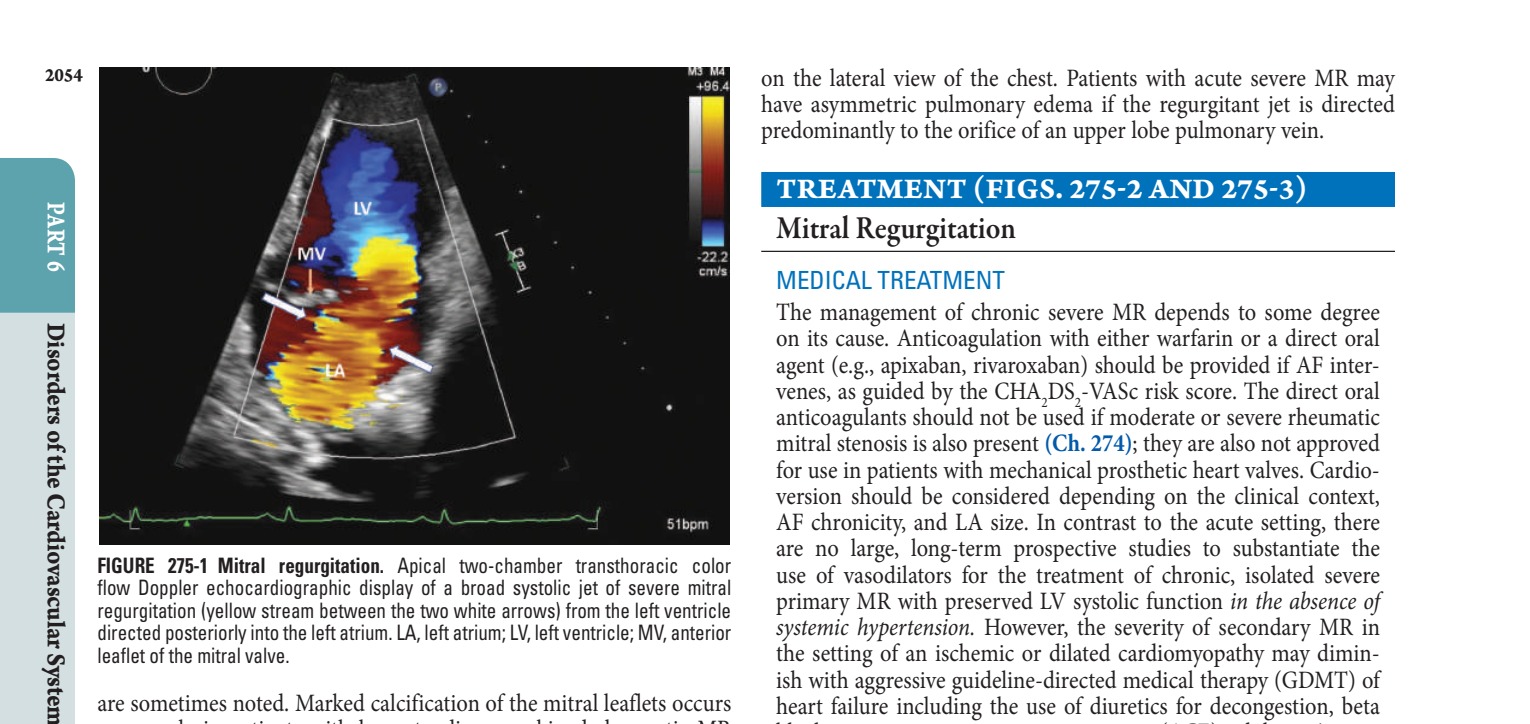 Mitral regurgitation
