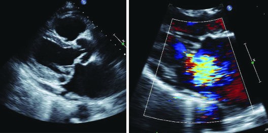 Barlow’s valve with classic mitral valve prolapse, as seen on...
