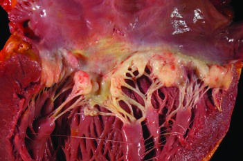 Mitral valve prolapse