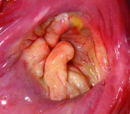Mitral valve prolapse