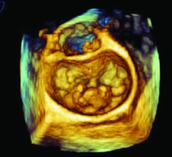 Mitral valve prolapse