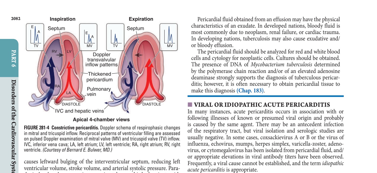 Constrictive pericarditis