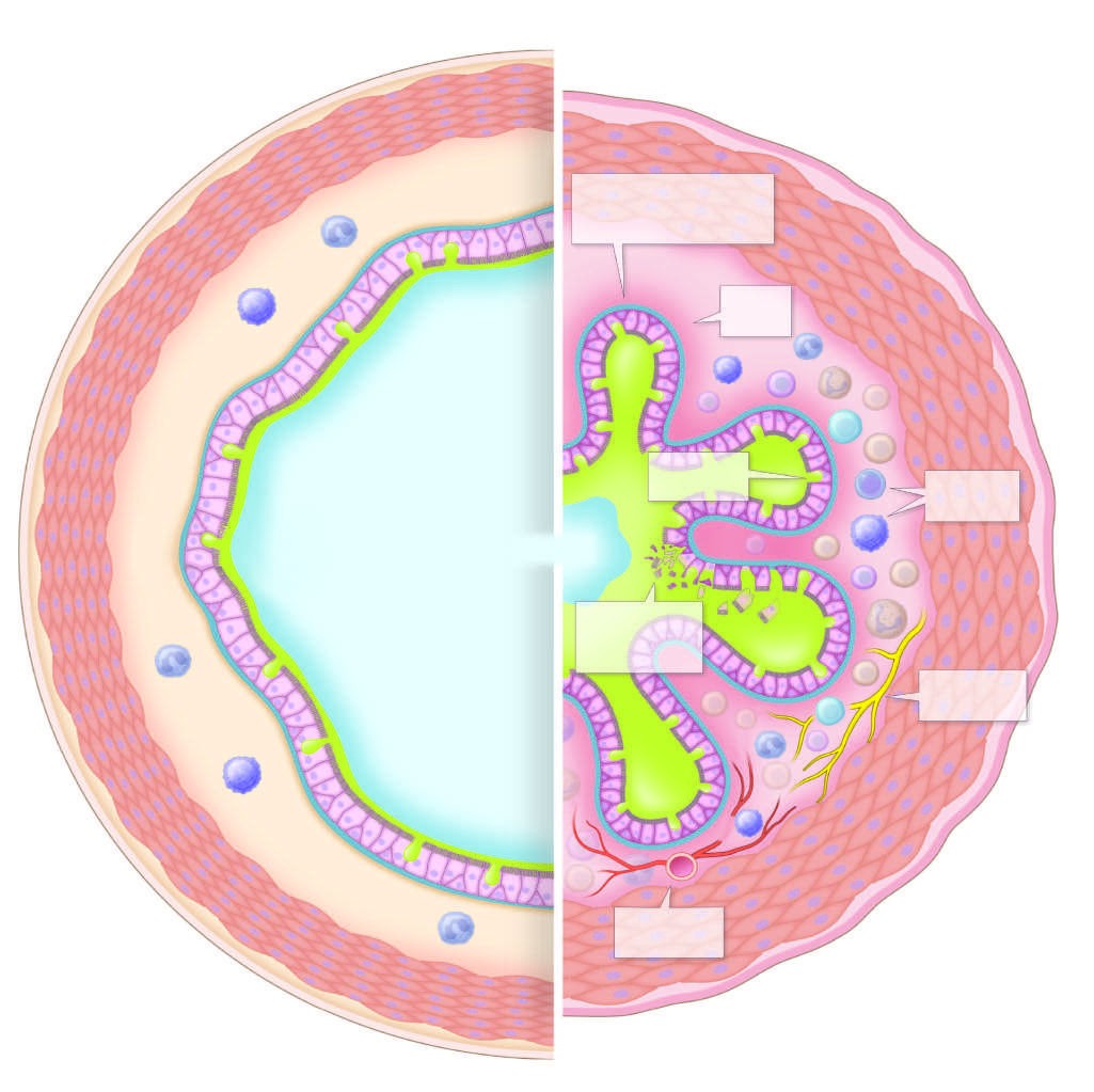 Pathologic changes that can be seen in asthmatic airways