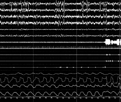 • Moderate OSAHS: AHI of 15–29 events/h FIGURE 308-3 Example...