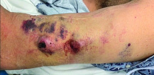 Dialysis access health depends on intra-access pressures and needle two...