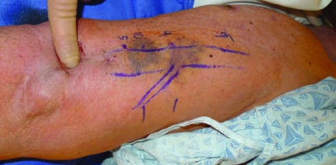 Dialysis access health depends on intra-access pressures and needle two...