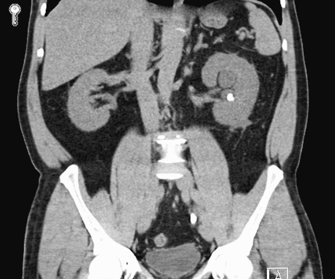 Urine sediment from a patient with calcium oxalate stones (left)...
