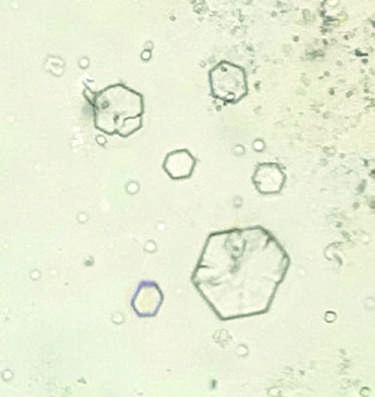 Urine sediment from a patient with calcium oxalate stones (left)...
