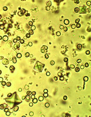 Urine sediment from a patient with calcium oxalate stones (left)...