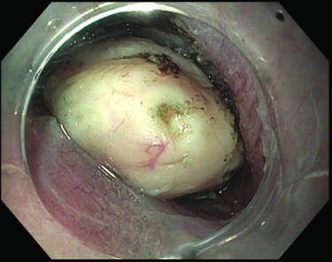 Peroral endoscopic tumorectomy (POET)