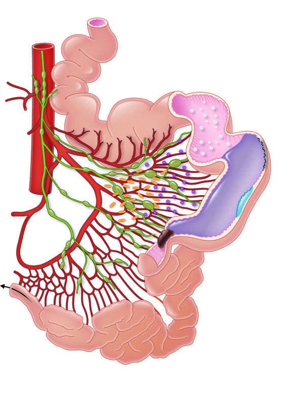 Pathophysiologic changes of small-bowel obstruction