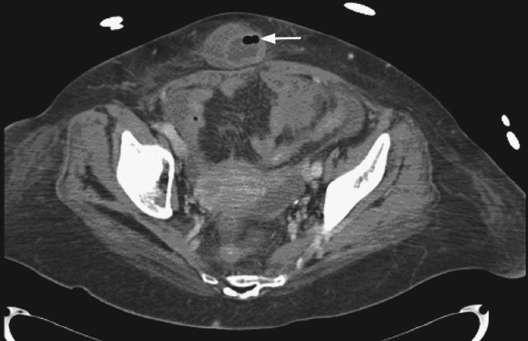 Computed tomography with oral and intravenous contrast demonstrating (A) evidence...