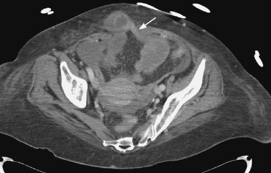 Computed tomography with oral and intravenous contrast demonstrating (A) evidence...