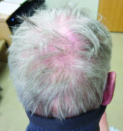 Characteristic musculoskeletal and cutaneous manifestations seen in chronic, nonerosive, and...