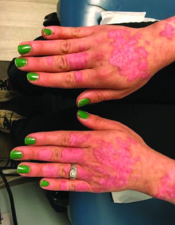 Characteristic musculoskeletal and cutaneous manifestations seen in chronic, nonerosive, and...