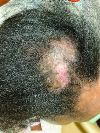 Characteristic musculoskeletal and cutaneous manifestations seen in chronic, nonerosive, and...