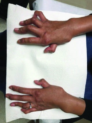 Characteristic musculoskeletal and cutaneous manifestations seen in chronic, nonerosive, and...