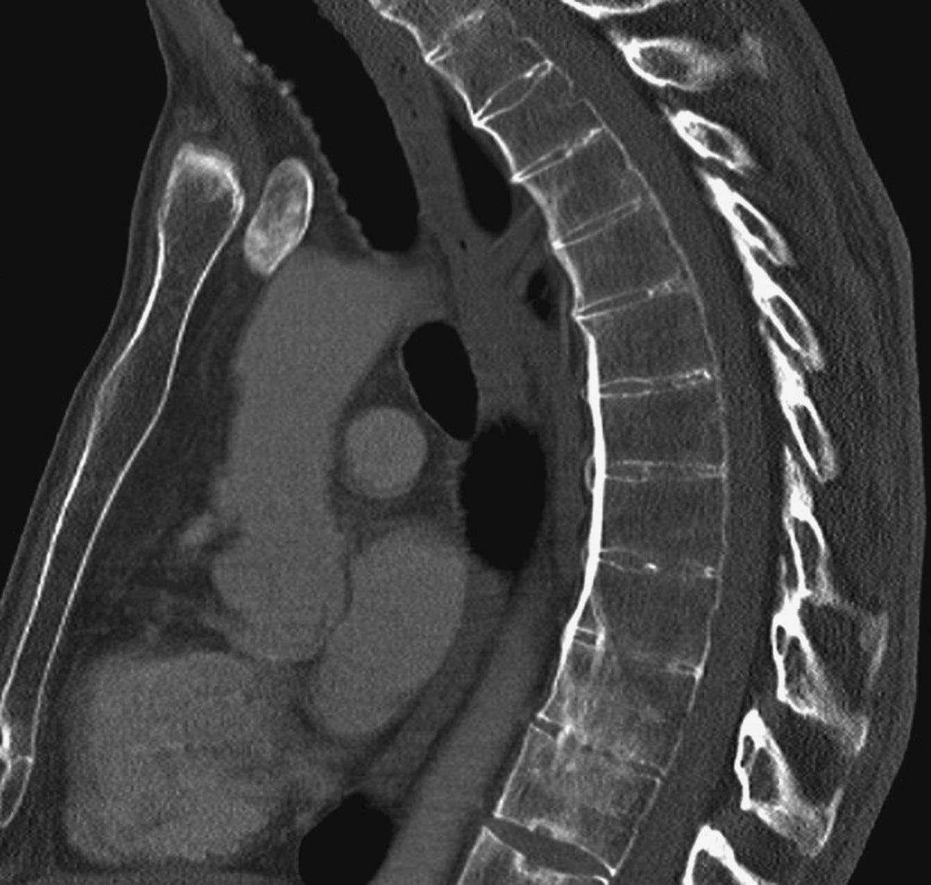 Computed tomography of the thoracic spine sagittal view in radiographic...