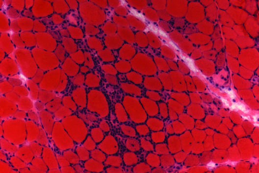 Pathology of polymyositis