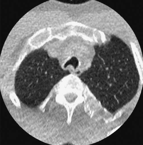Airway involvement in relapsing polychondritis