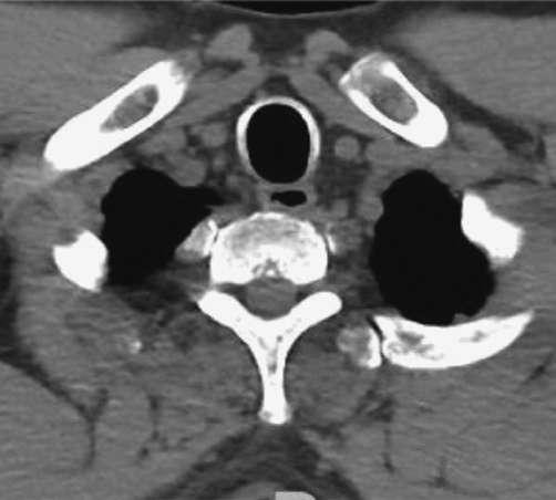 Airway involvement in relapsing polychondritis