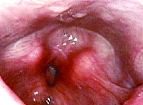 Airway involvement in relapsing polychondritis