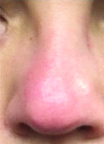 (Continued) *— Figure 378-2A: Redness and swelling of the base...